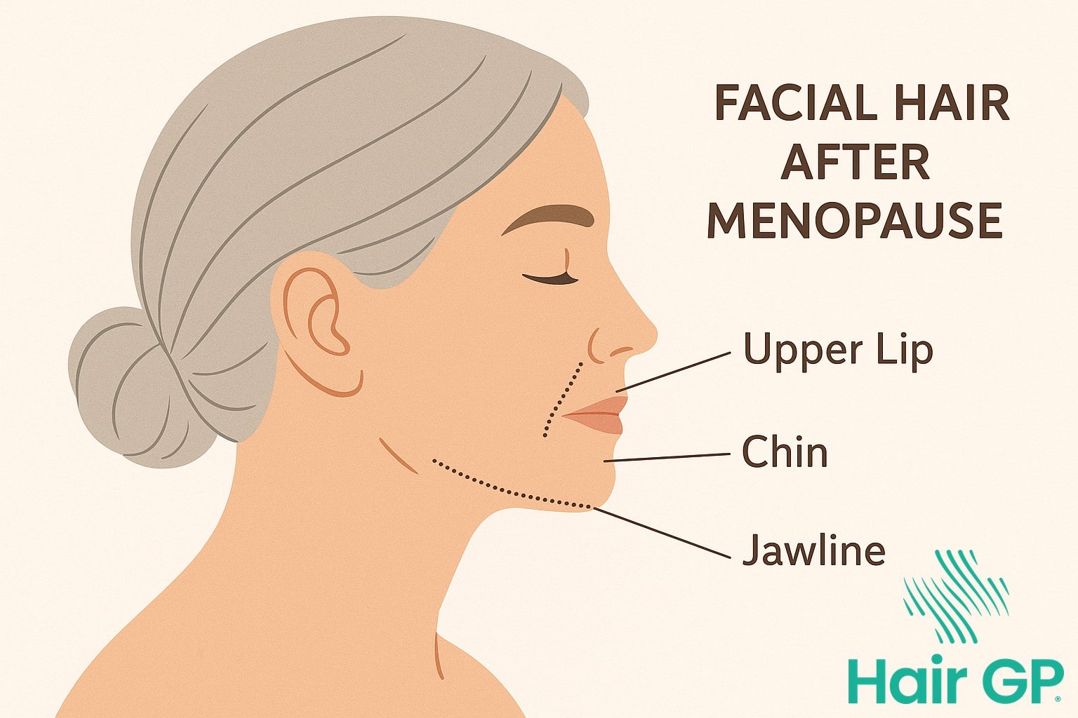 Illustration showing common facial hair growth areas in menopausal women