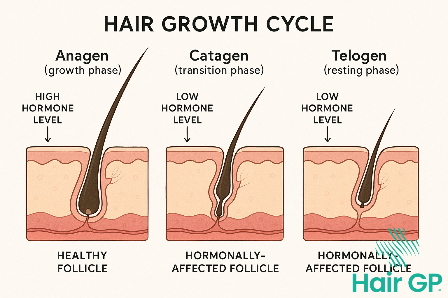 Diagram showing hair growth cycle phases and hormone effects on follicles
