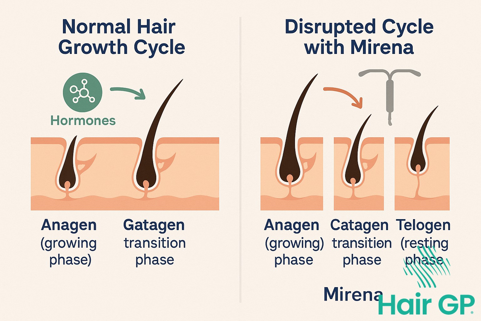 Infographic showing how Mirena affects hair growth cycles
