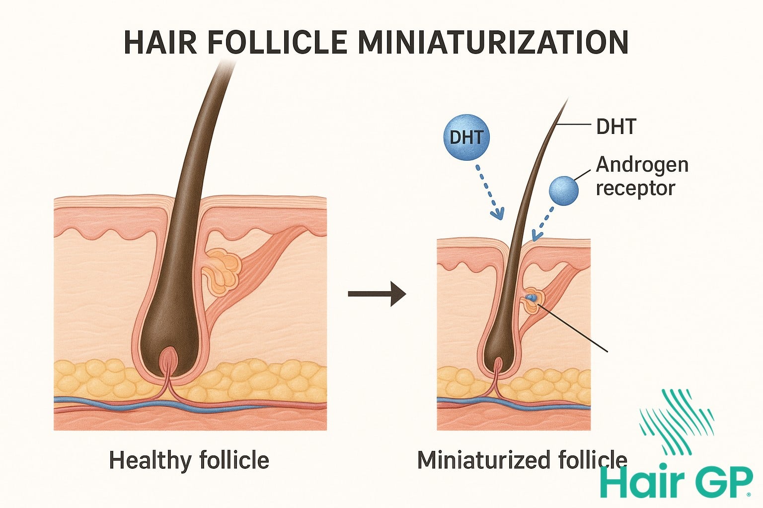 Illustration showing how DHT causes hair follicle miniaturization in male pattern baldness