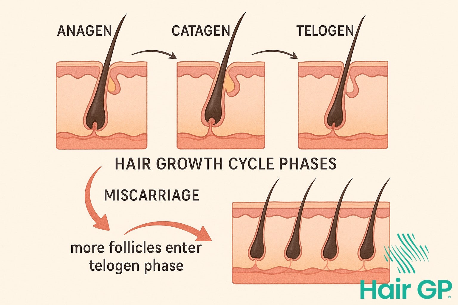 Illustration of hair growth cycle showing how miscarriage affects follicle phases