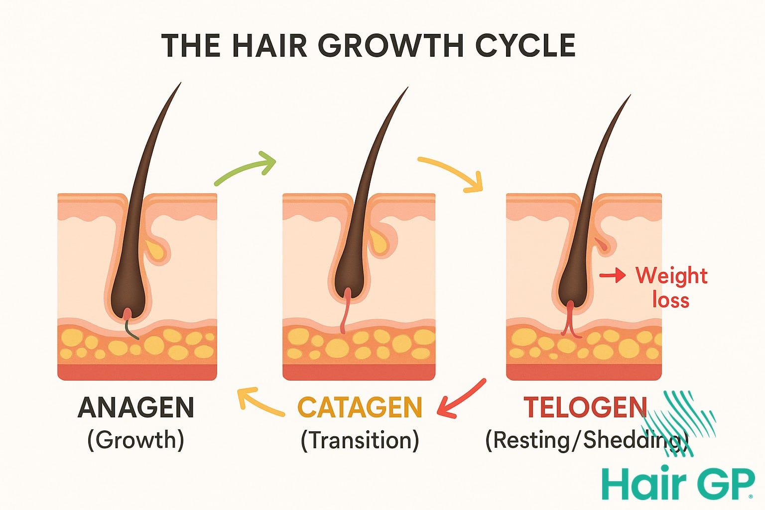 Diagram of hair growth cycle showing telogen effluvium from weight loss