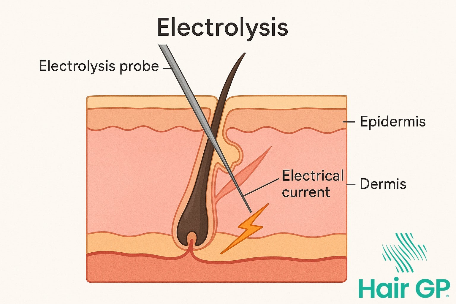 Diagram showing how electrolysis destroys hair follicles with electrical current