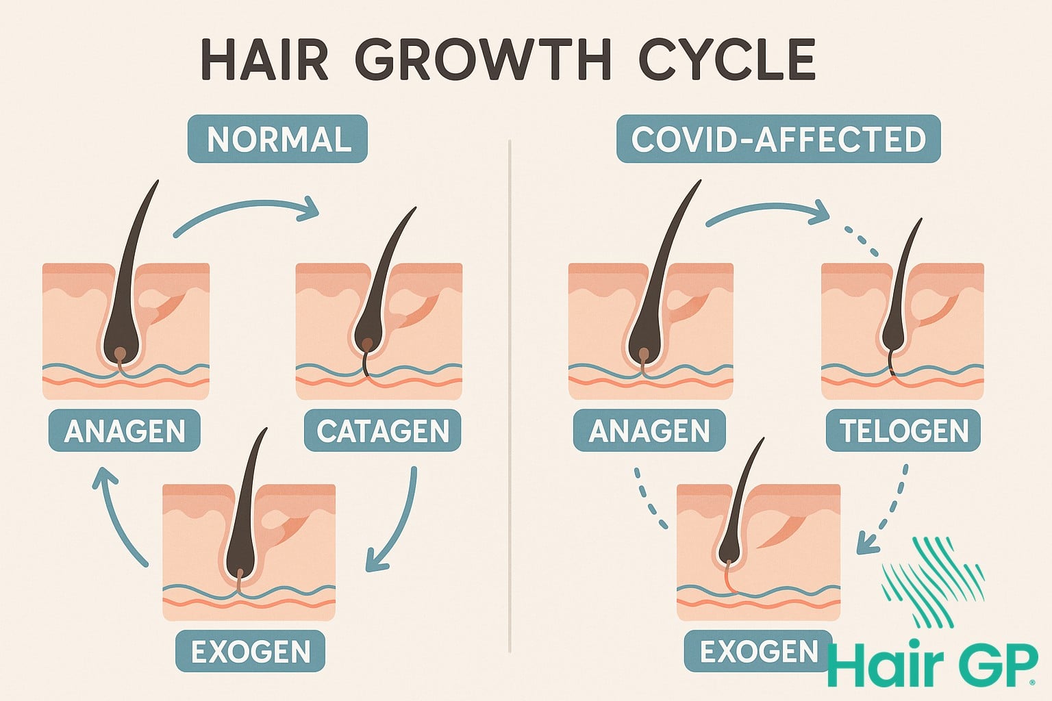 Diagram comparing normal hair growth cycle with COVID-disrupted telogen phase
