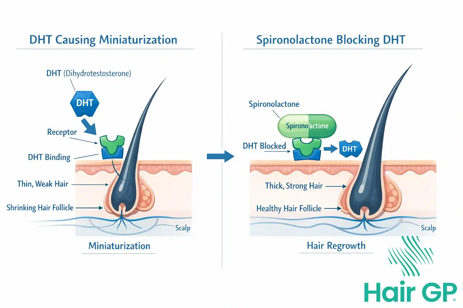 Spironolactone for Hair Loss in Women - Hair GP